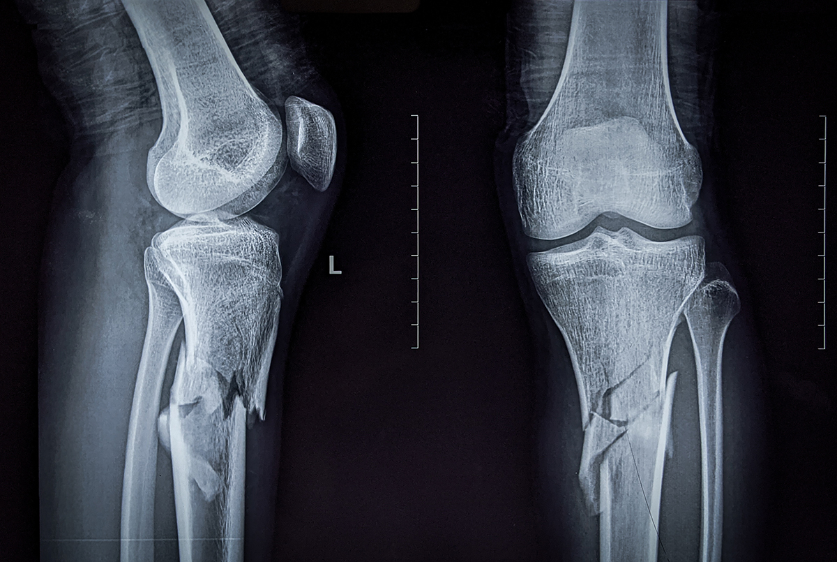 Frequently Encountered Aviation Injuries
